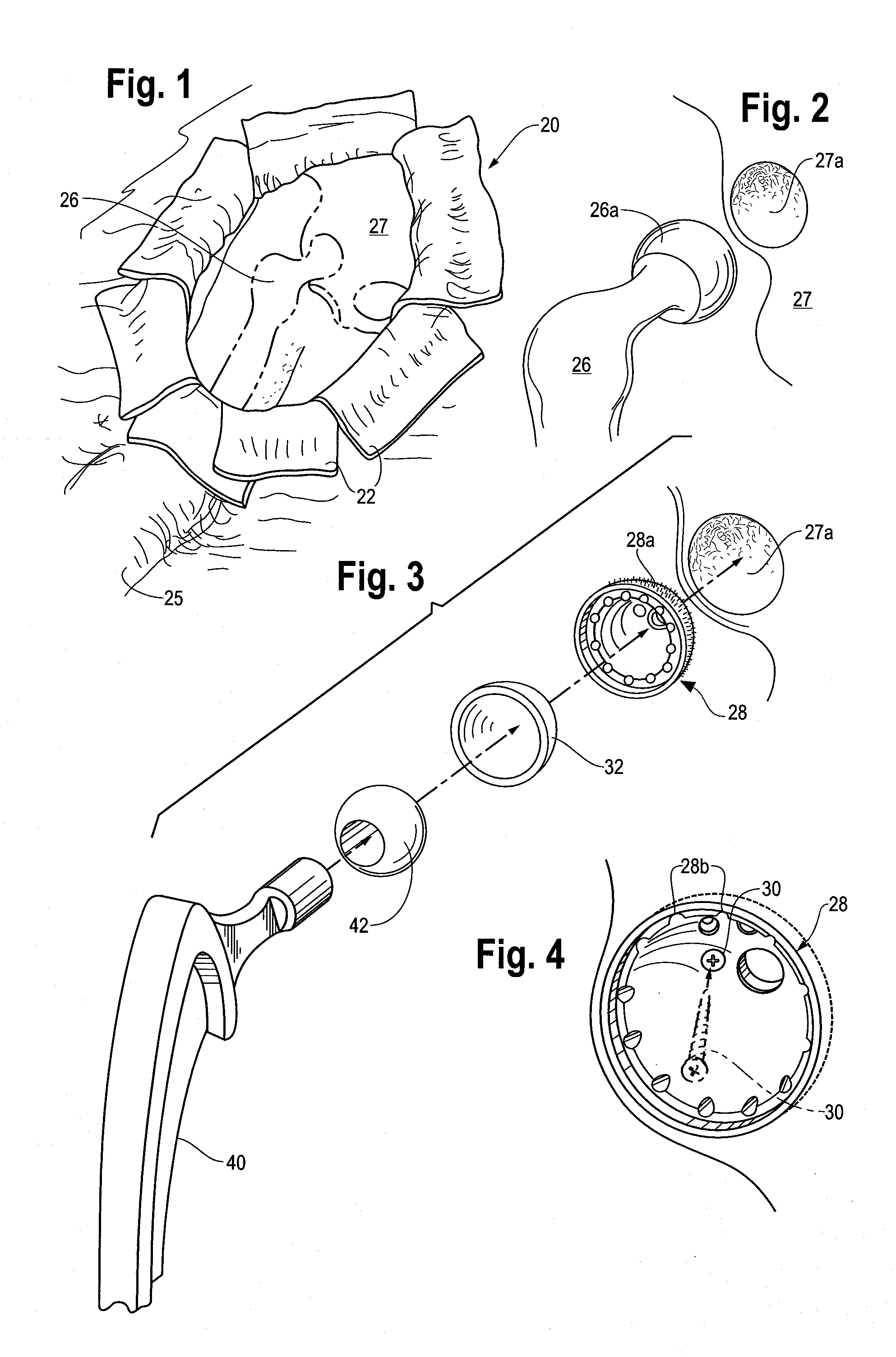 Surgical insertion device for use in orthopedic surgery