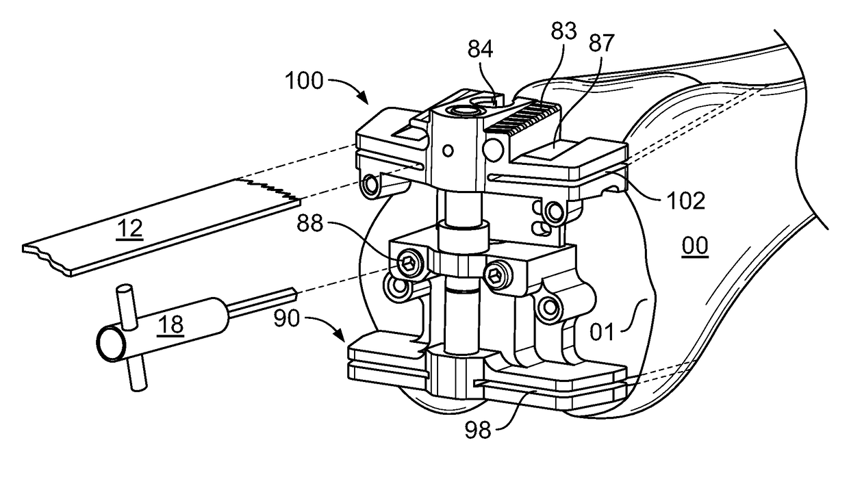 Globalized total knee instrumentation