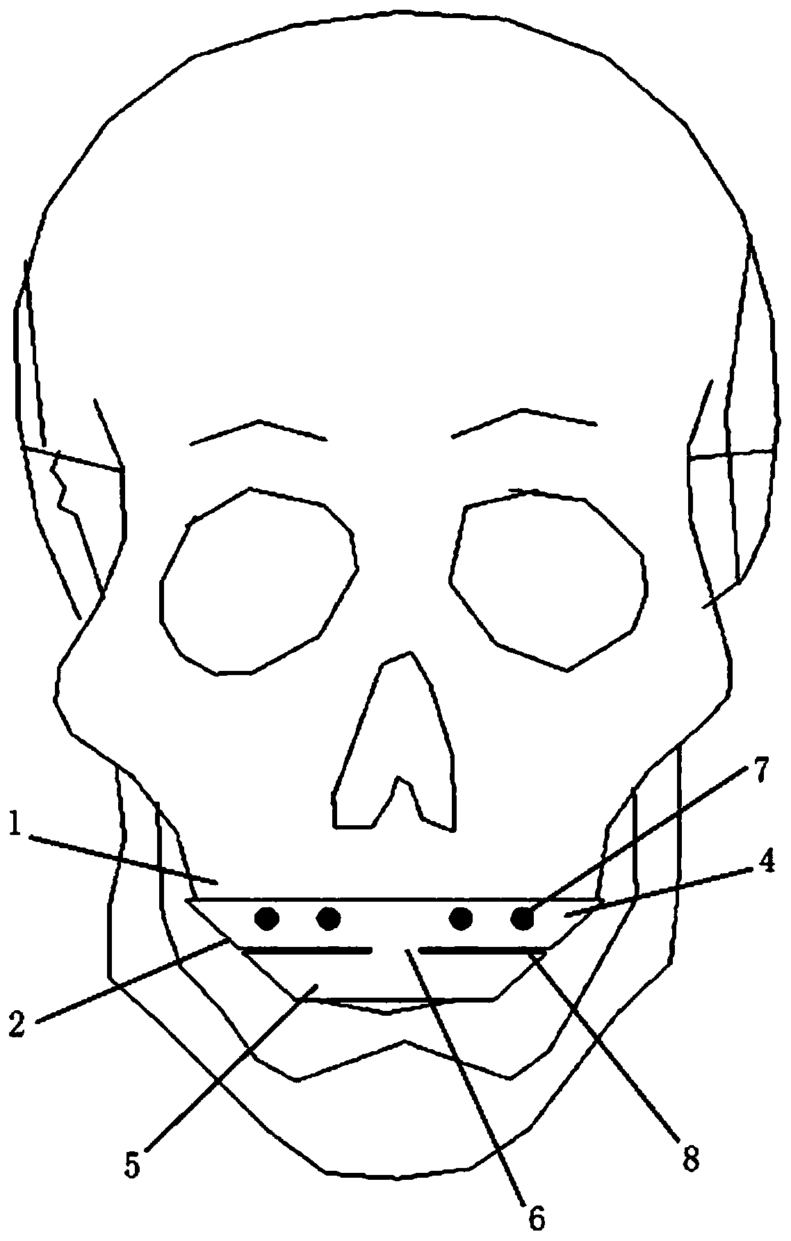 Titanium alloy maxillary alveolar bone osteotomy guide plate generated through three-dimensional printing technology