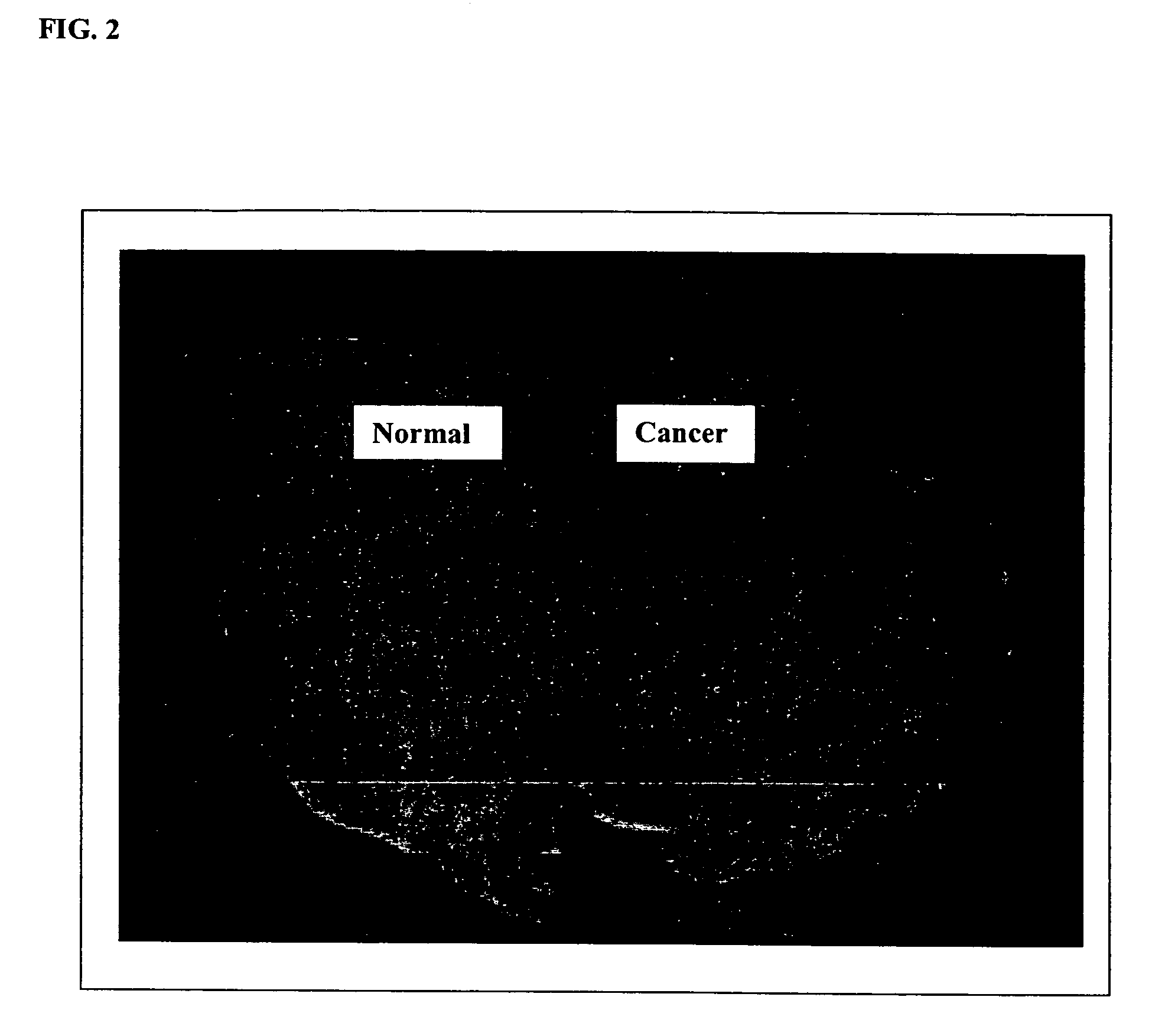 Detecting human cancer through spectral optical imaging using key water absorption wavelengths