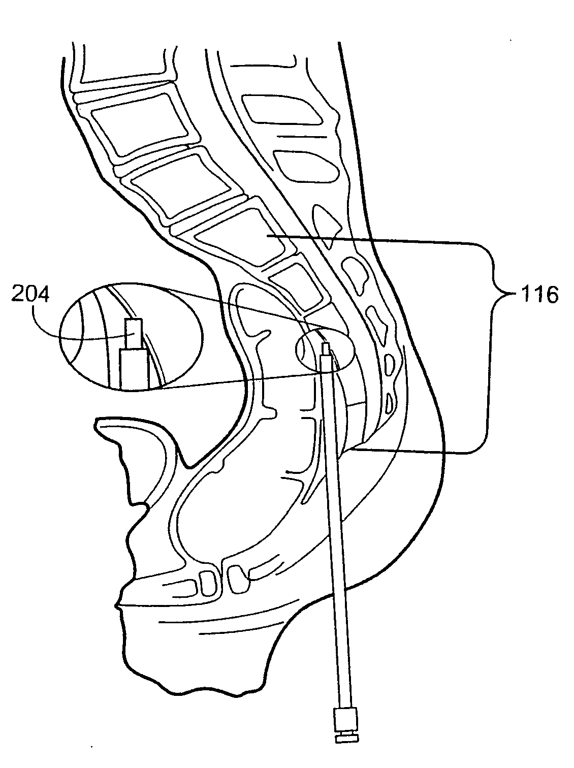 Surgical cutter with exchangeable cutter blades