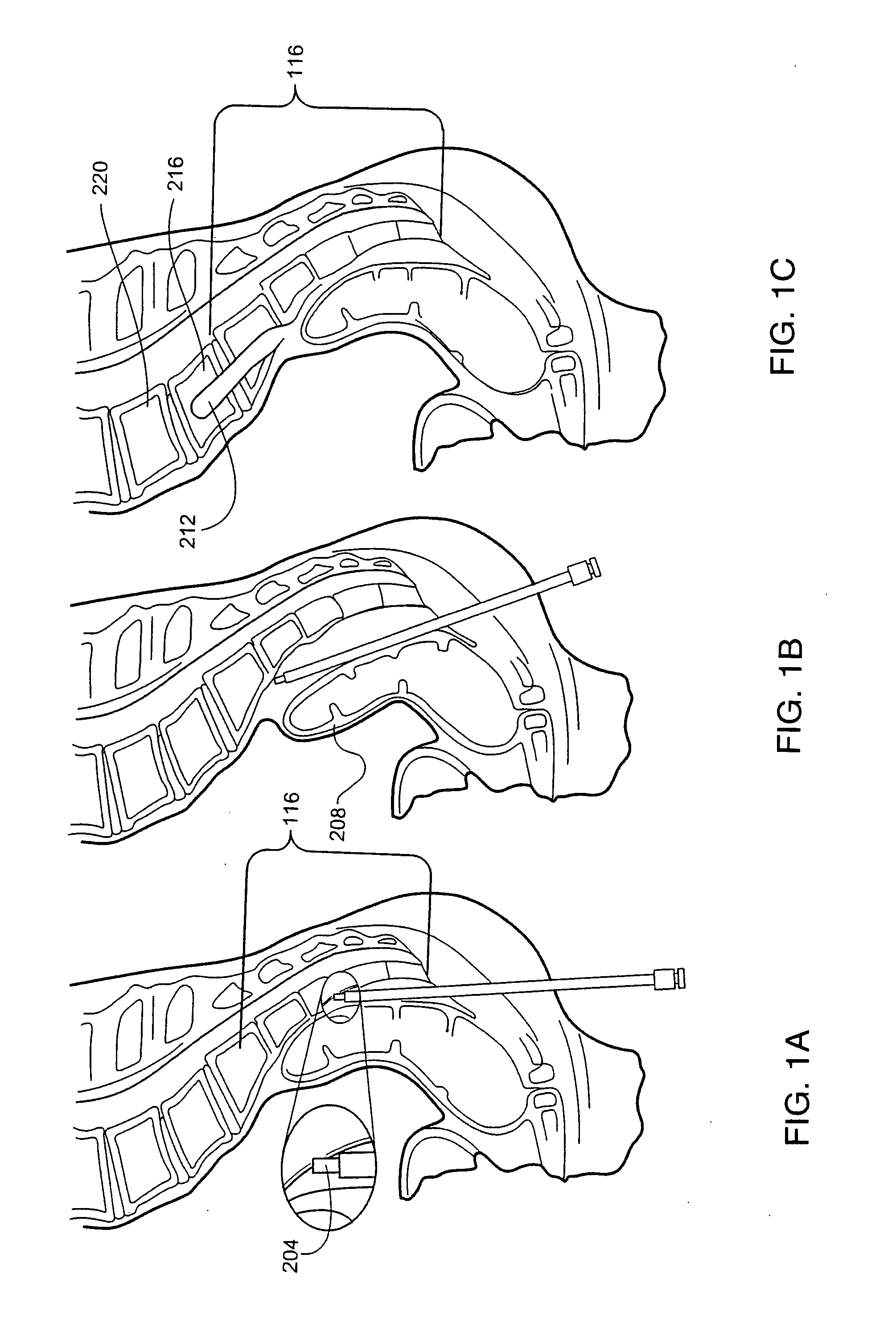 Surgical cutter with exchangeable cutter blades