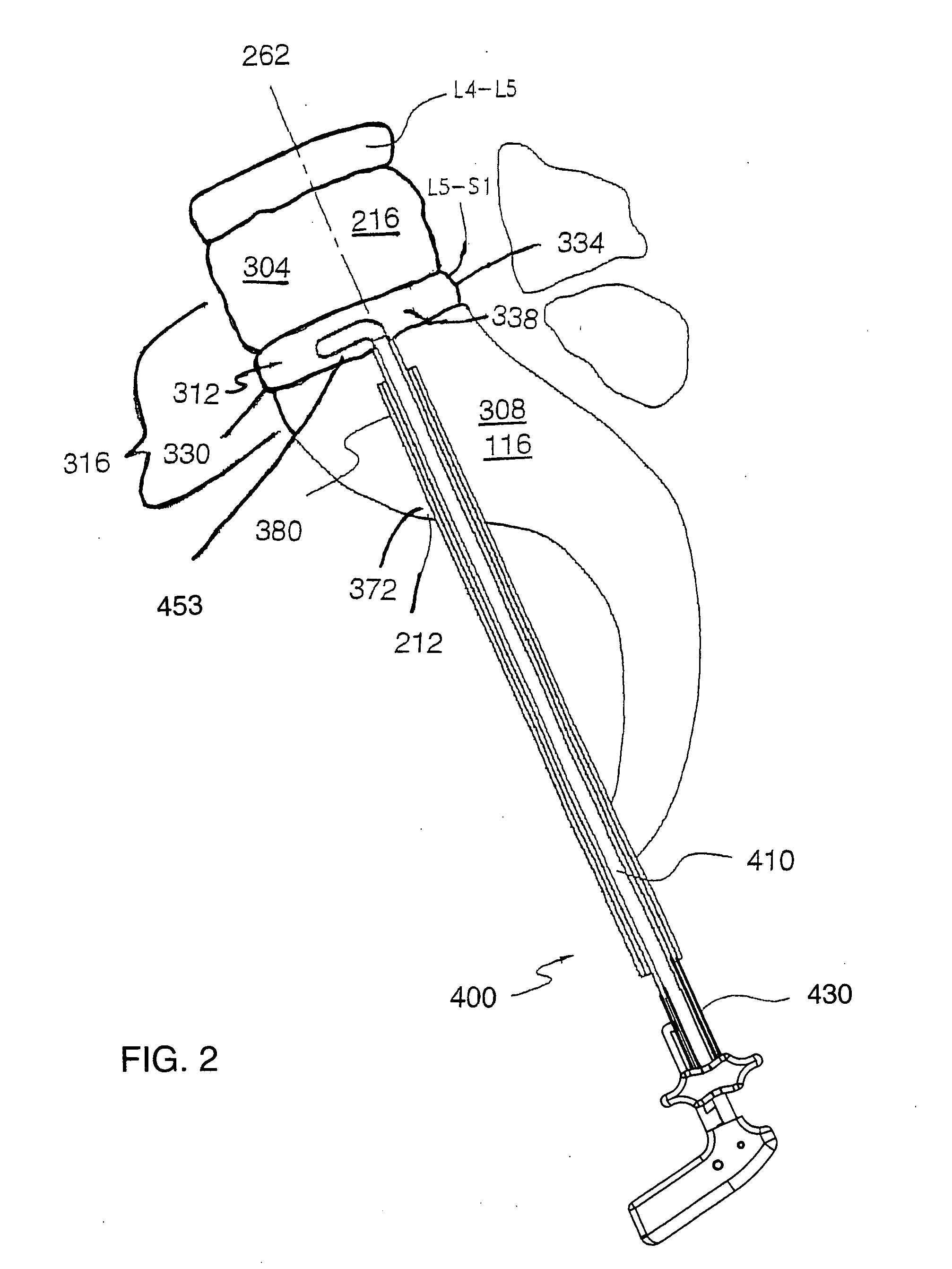 Surgical cutter with exchangeable cutter blades