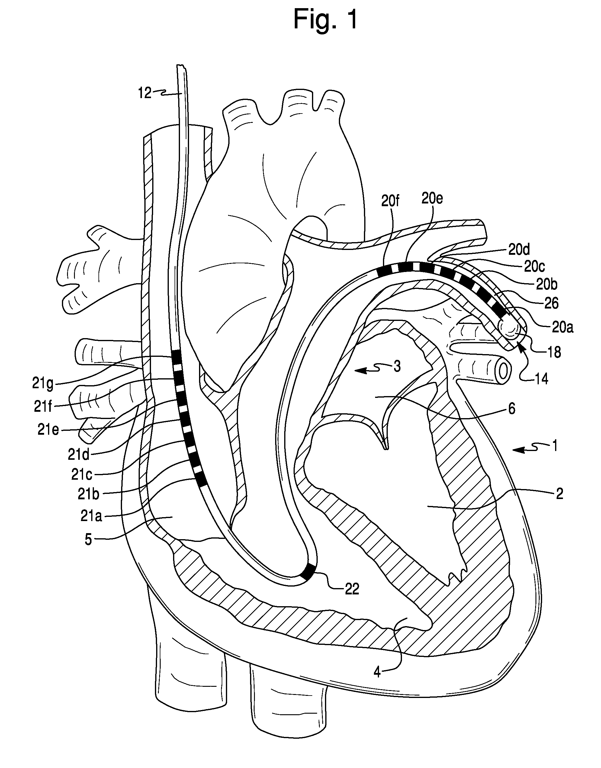 Method For Simultaneous Bi-Atrial Mapping Of Atrial Fibrillation