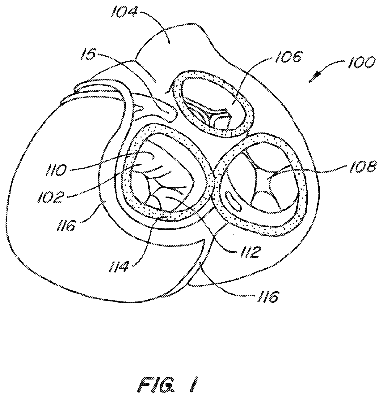 Mitral valve annuloplasty device with twisted anchor