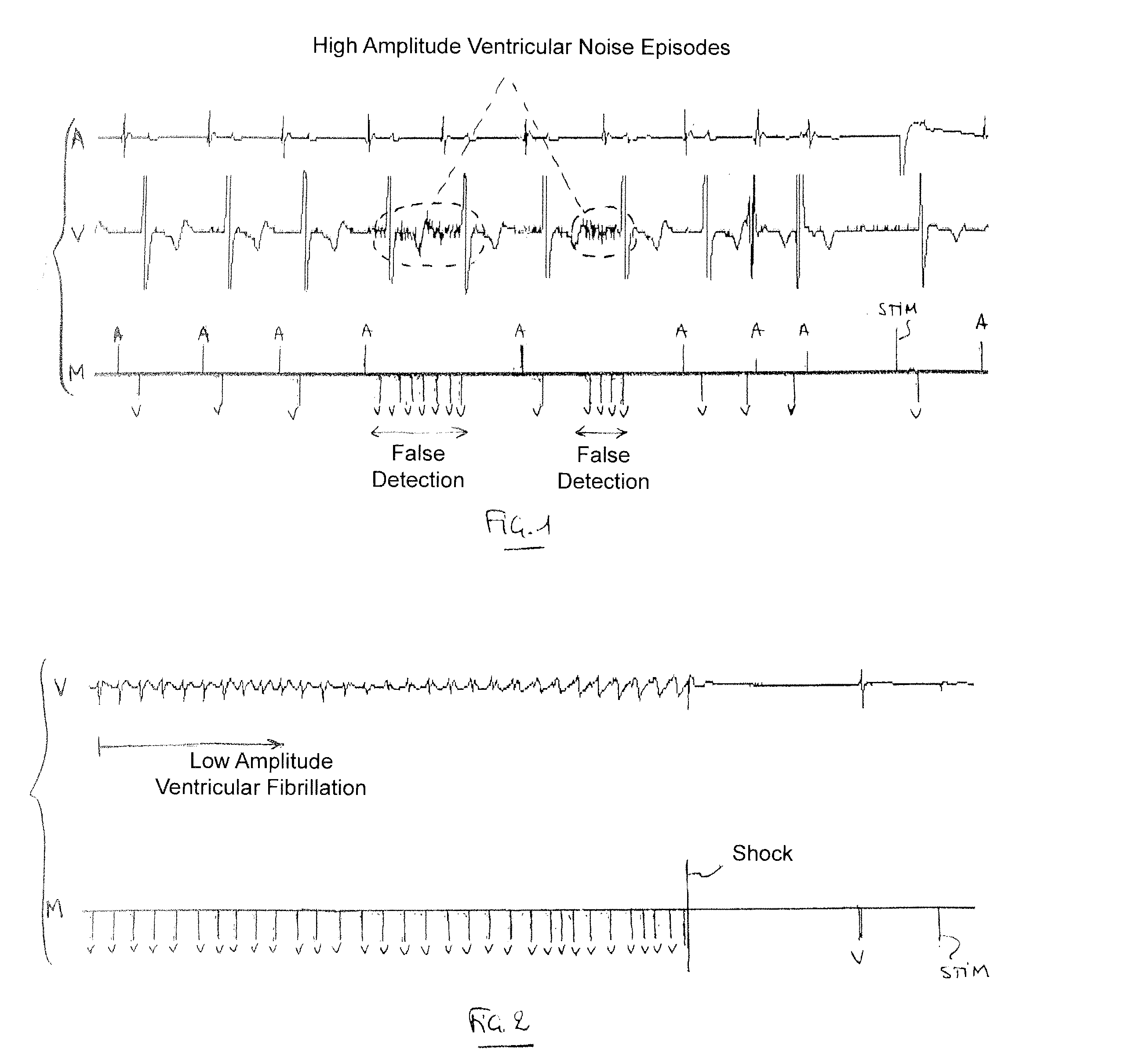 Implantable defibrillator/cardioverter medical device with a dynamically adjustable threshold for ventricular detection