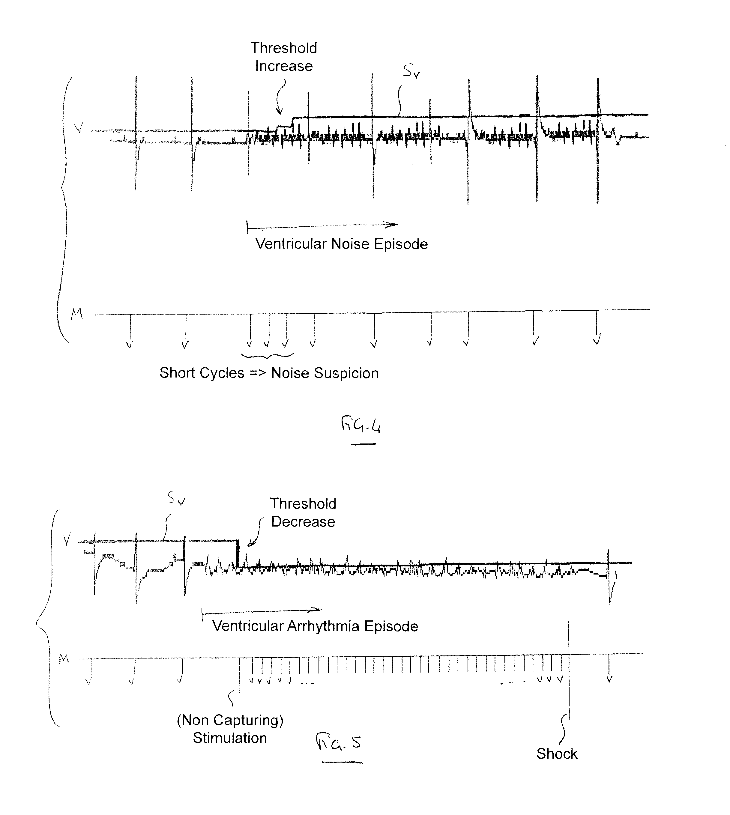 Implantable defibrillator/cardioverter medical device with a dynamically adjustable threshold for ventricular detection