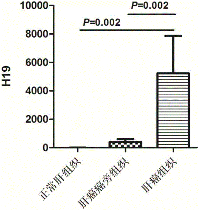 Liver cancer diagnosing reagent and kit using saliva as detection samples