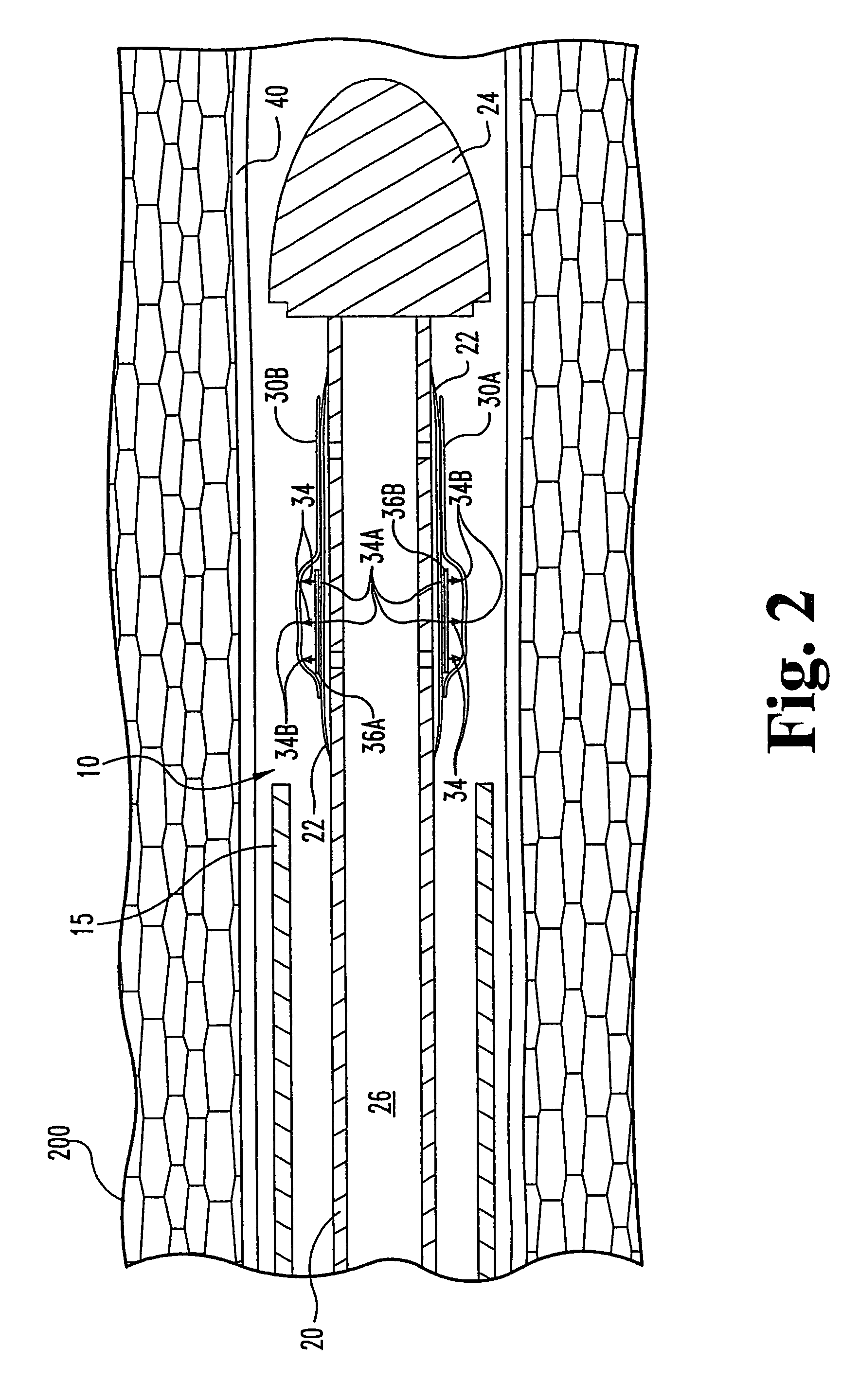 Methods and devices for the endoluminal deployment and securement of prostheses