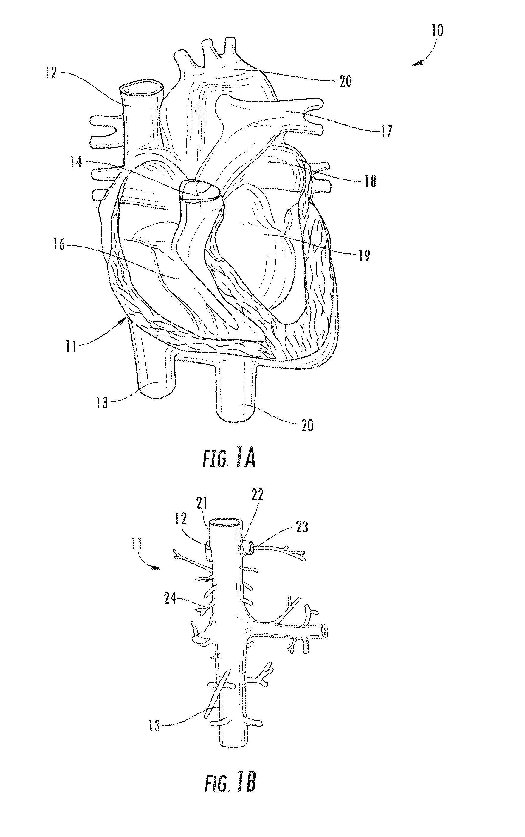 Systems and methods for treating acute and chronic heart failure