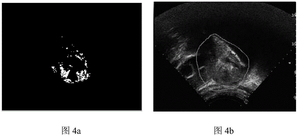 Extraction method of vascular perfusion area in contrast-enhanced ultrasound images based on brox optical flow method