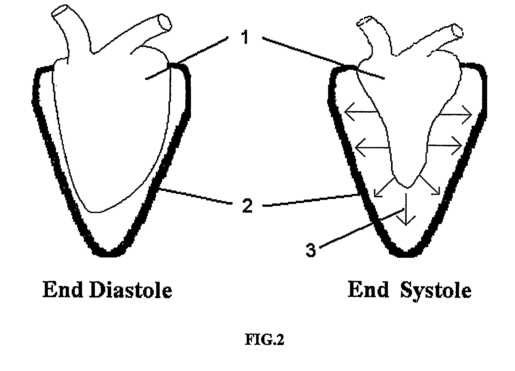 In vivo for improving diastolic ventricular function