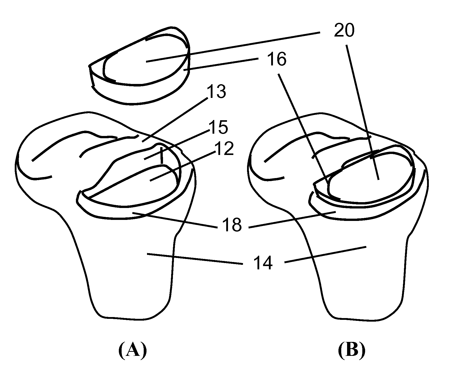 Midlay compartmental tibial component