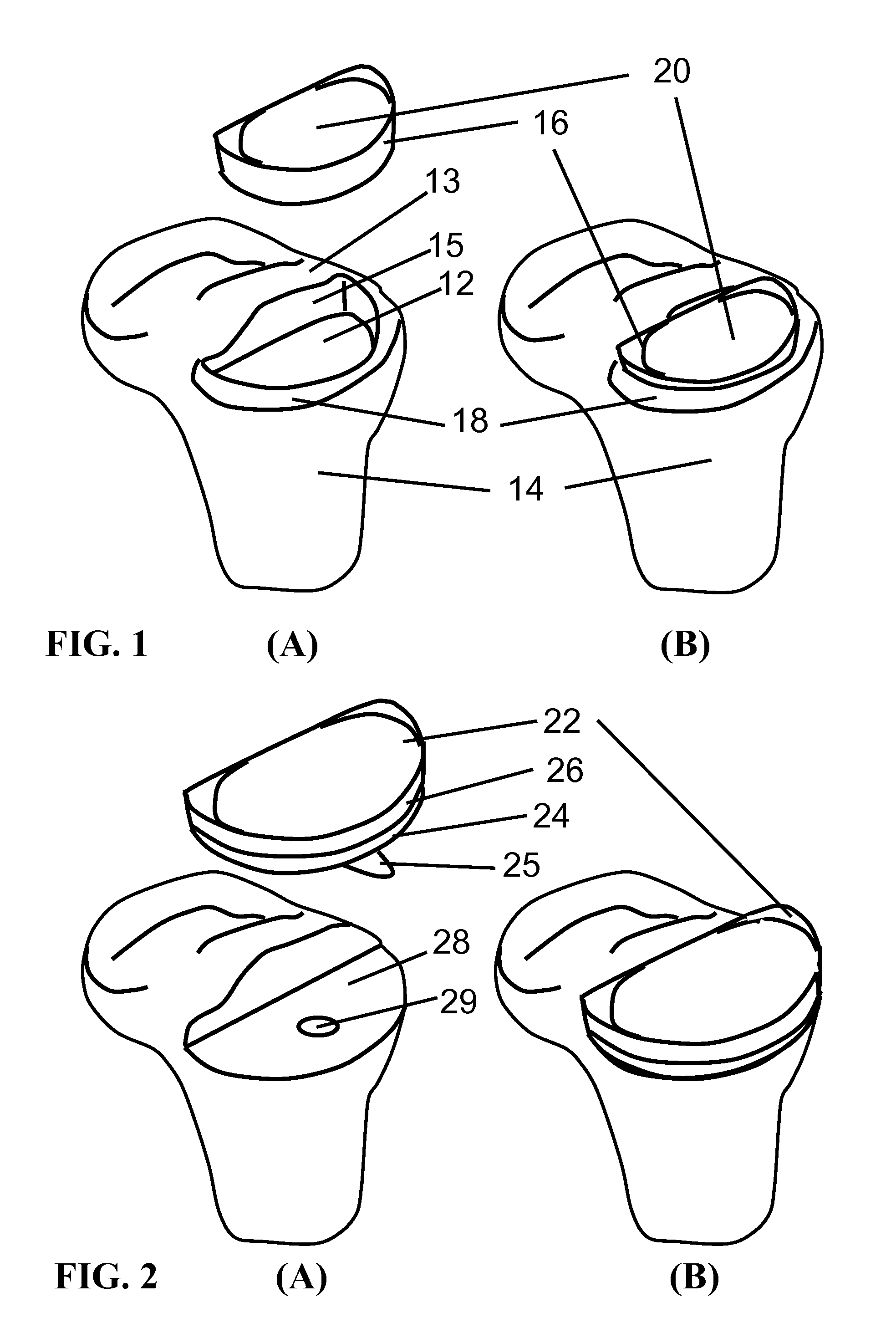 Midlay compartmental tibial component