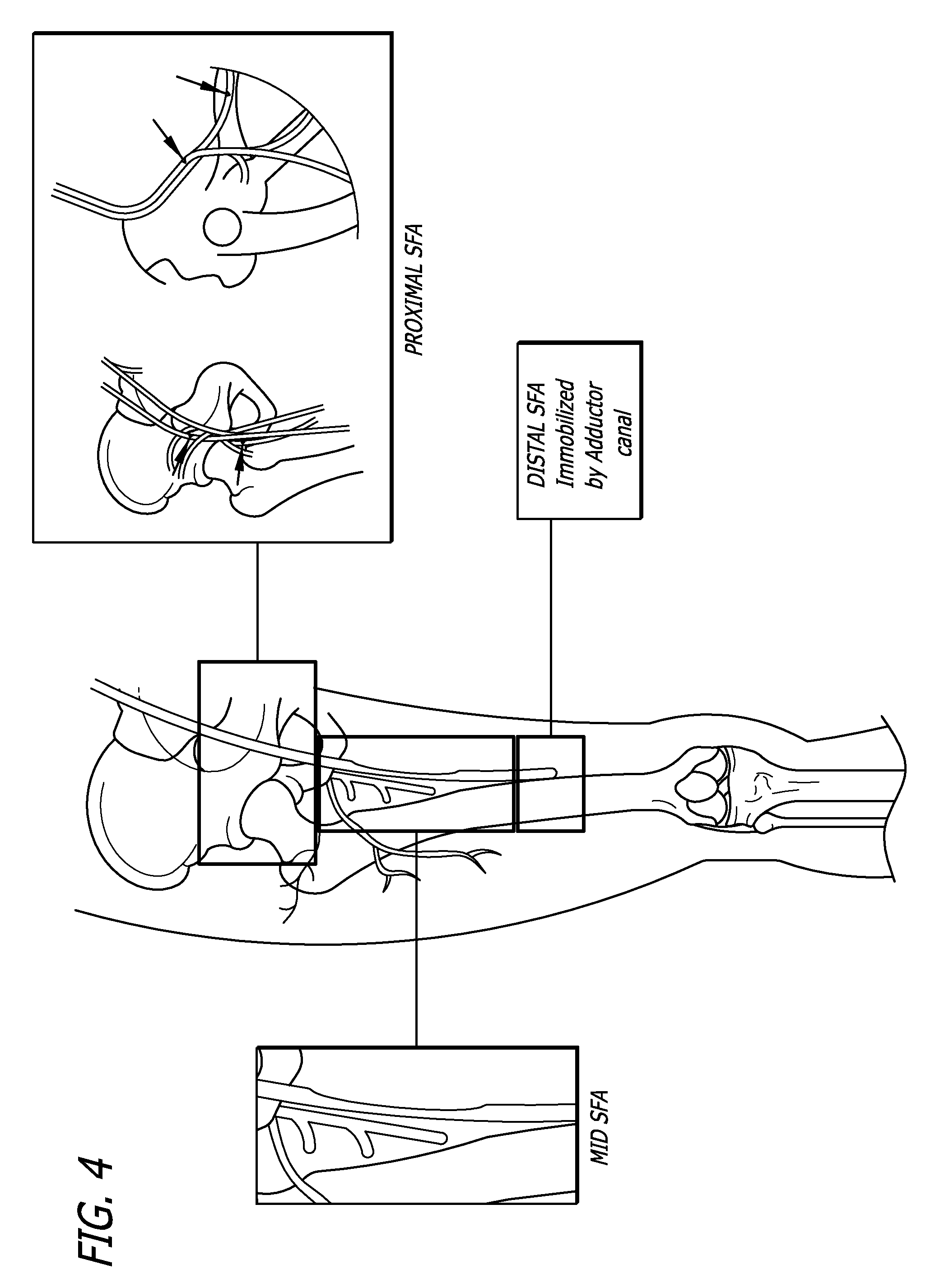 Endoprostheses for peripheral arteries and other body vessels