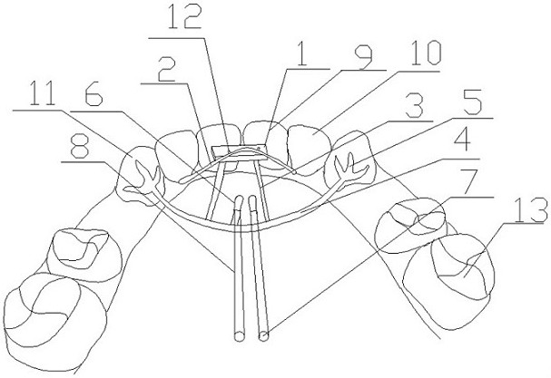 Orthodontic device for assisting mandibular protraction and adduction of upper anterior teeth