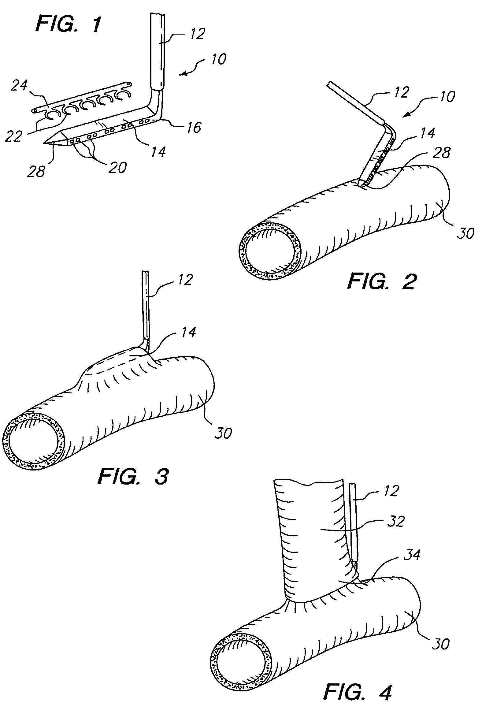 System for performing anastomosis