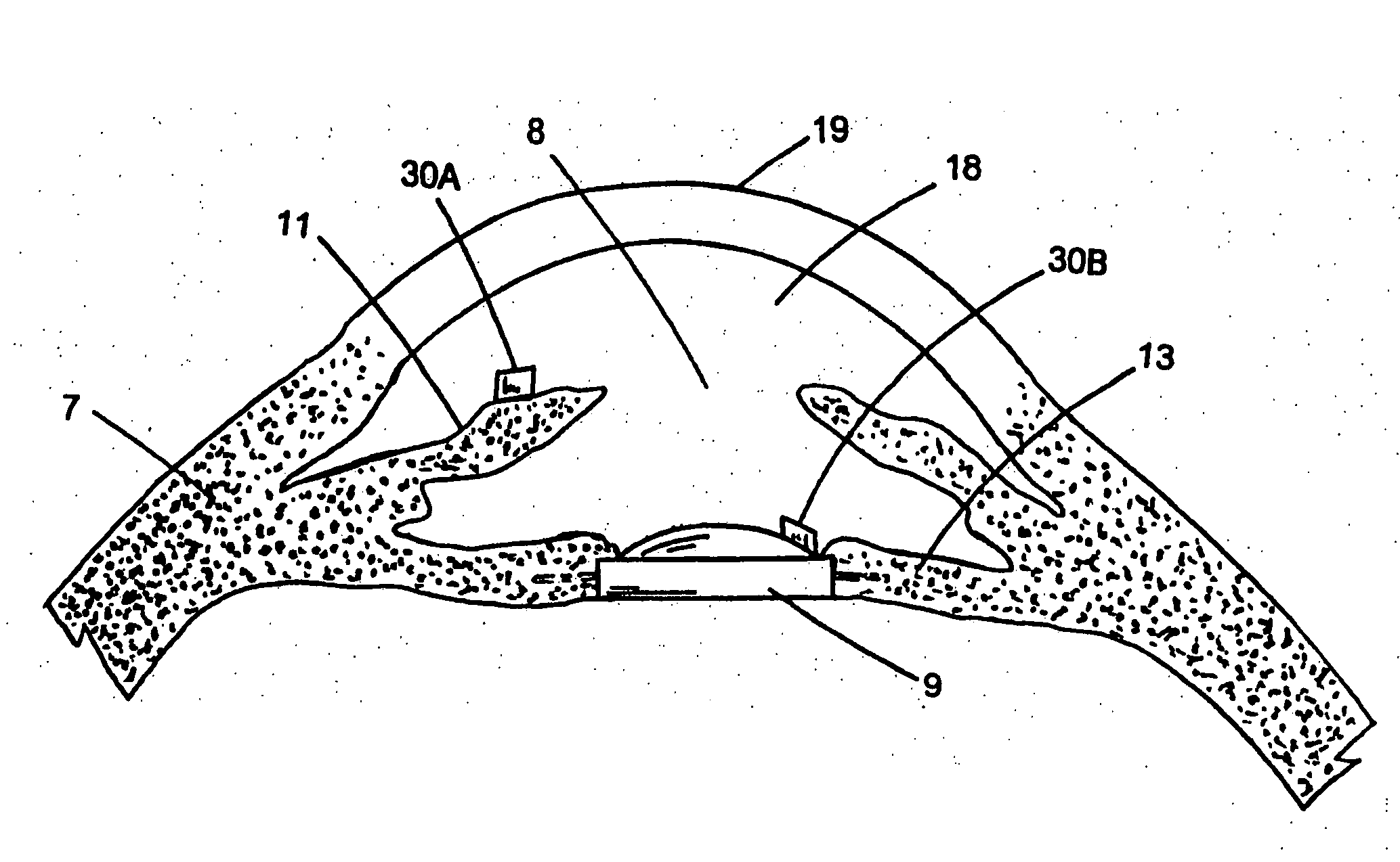 Optically powered and optically data-transmitting wireless intraocular pressure sensor device