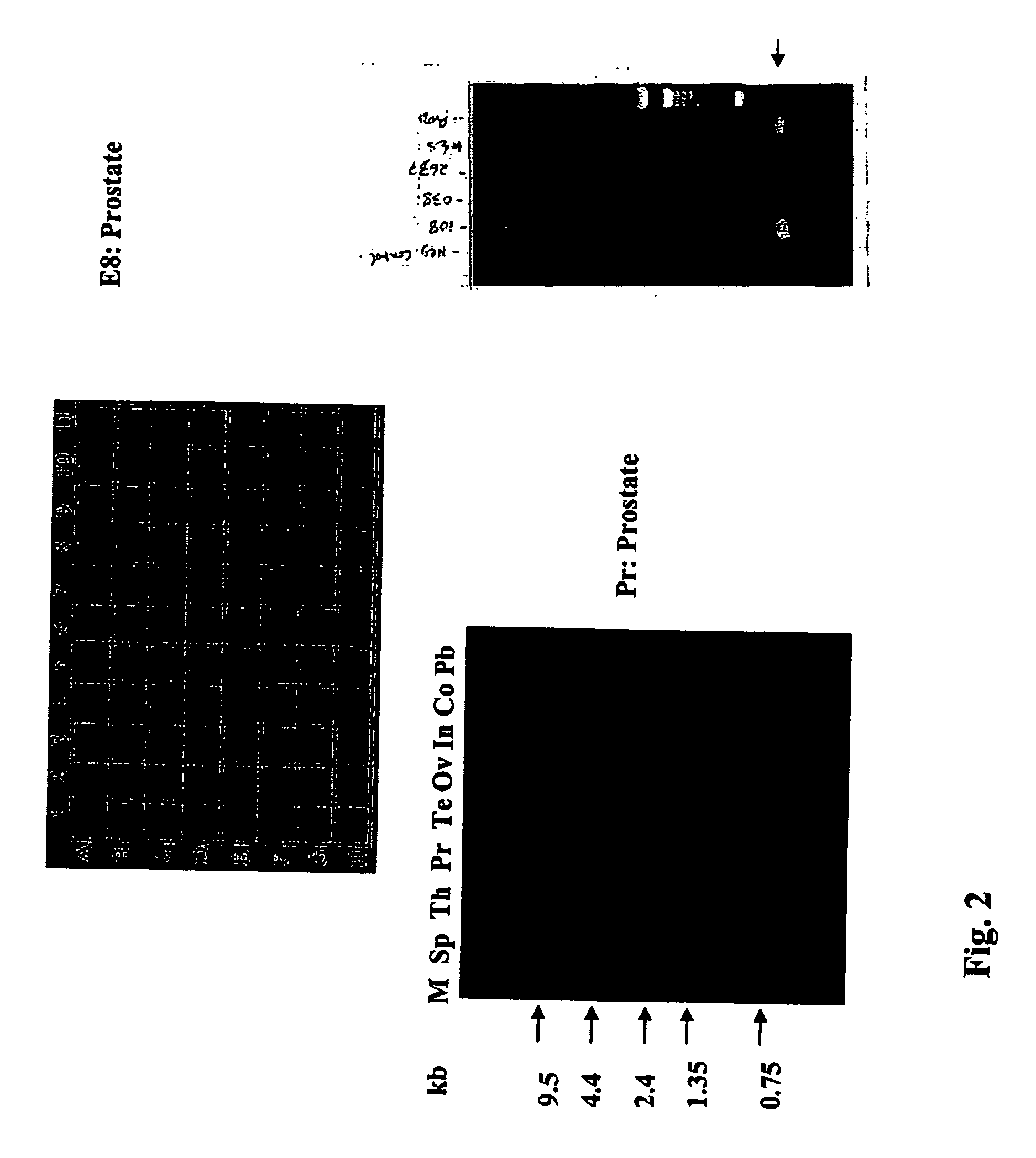 Gene expressed in prostate cancer, methods and use thereof