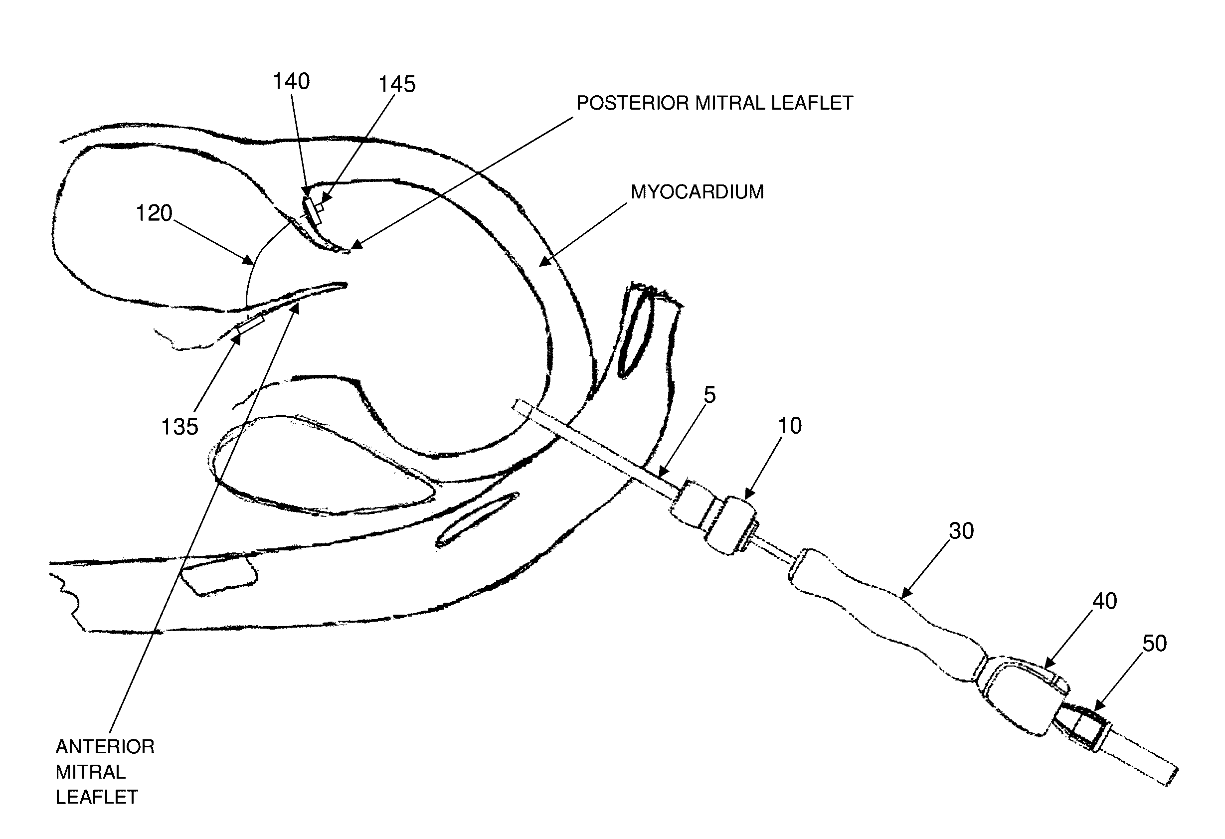 Method and apparatus for repairing a mitral valve