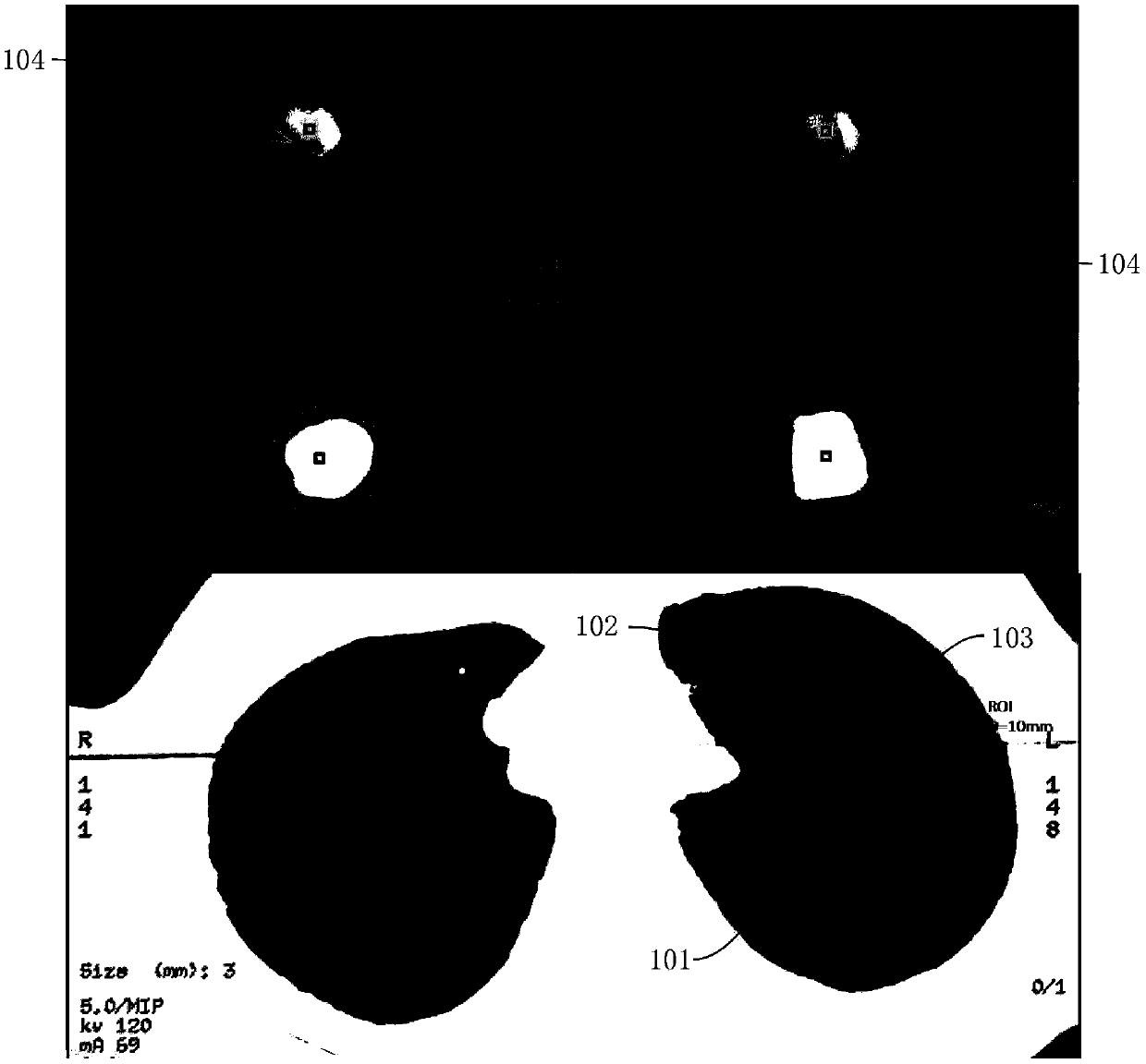 Optimizing method of chest low-dose CT scanning parameters