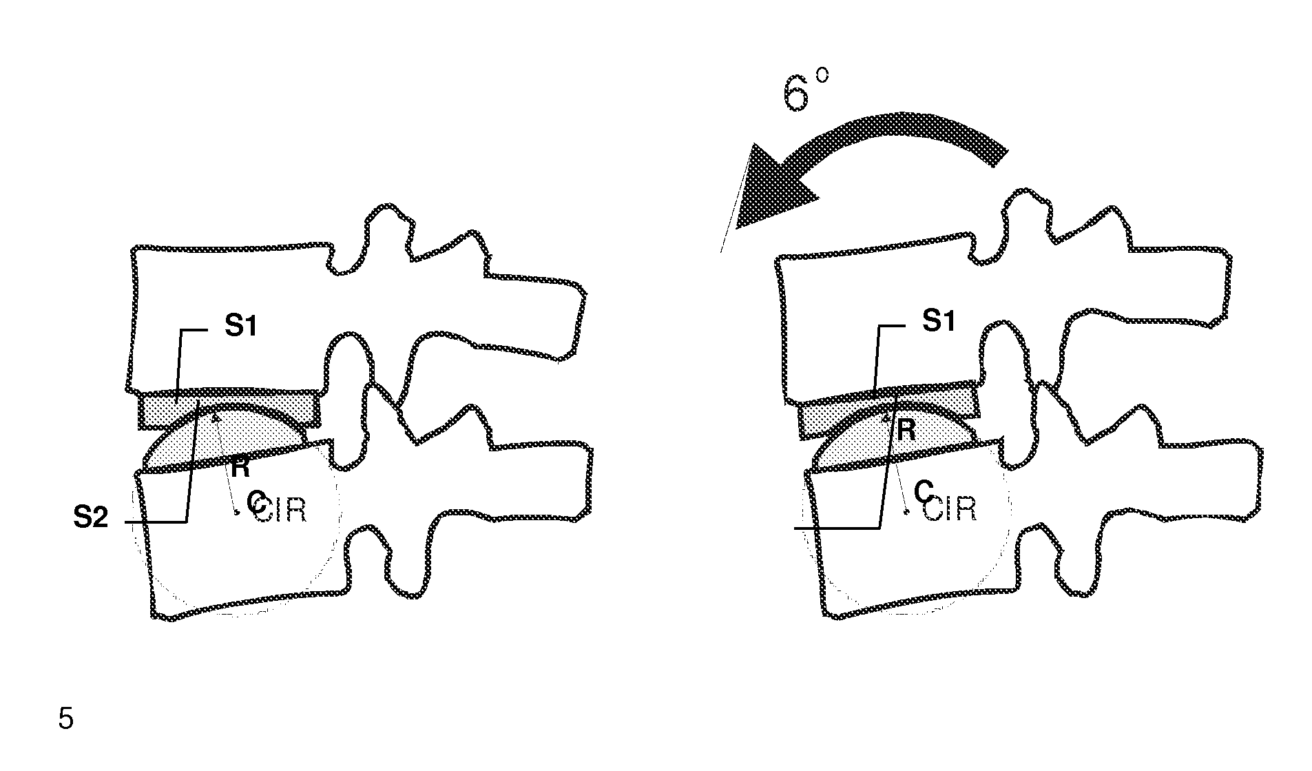 Intervertebral disc prosthesis for universal application