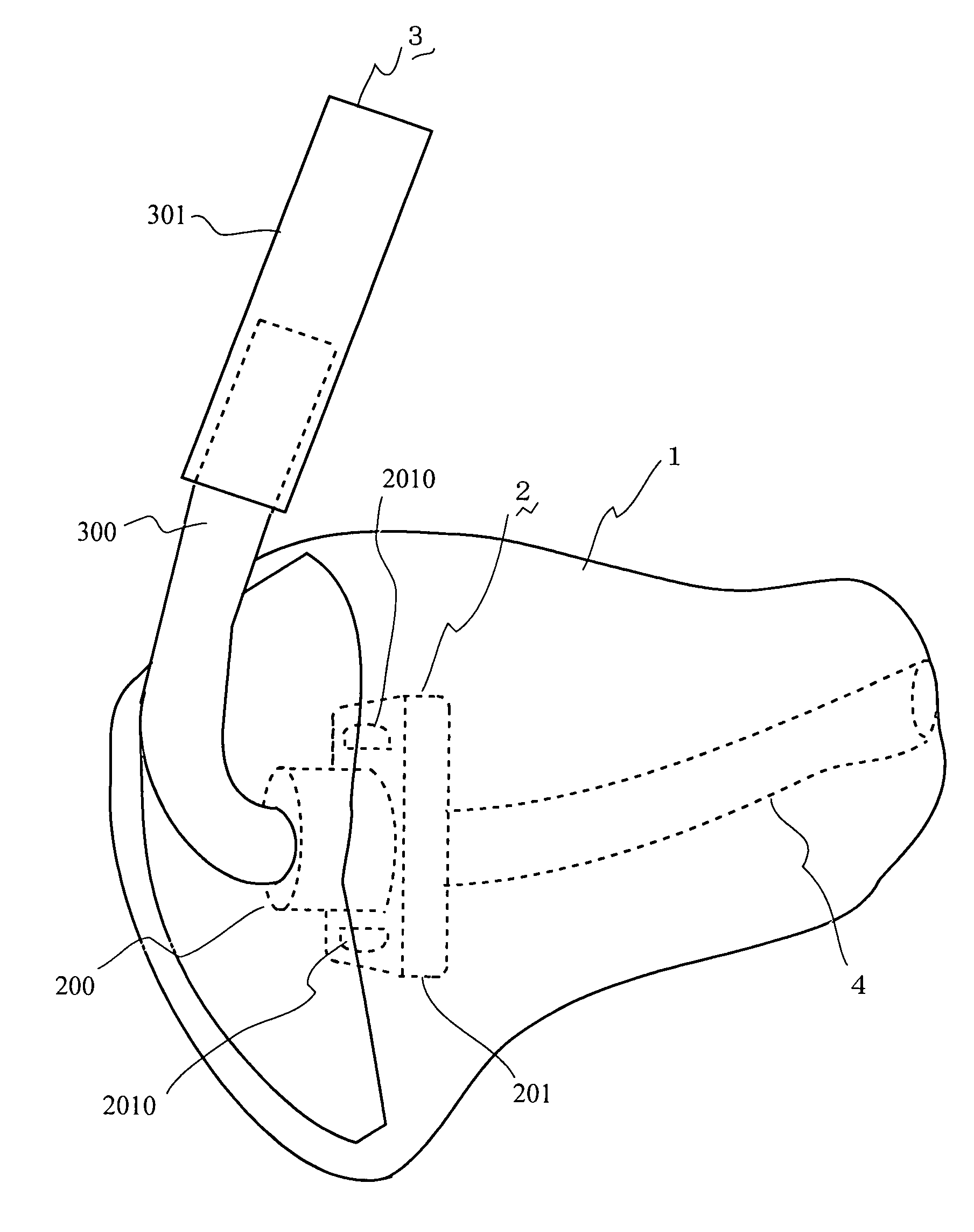 Ear Mold