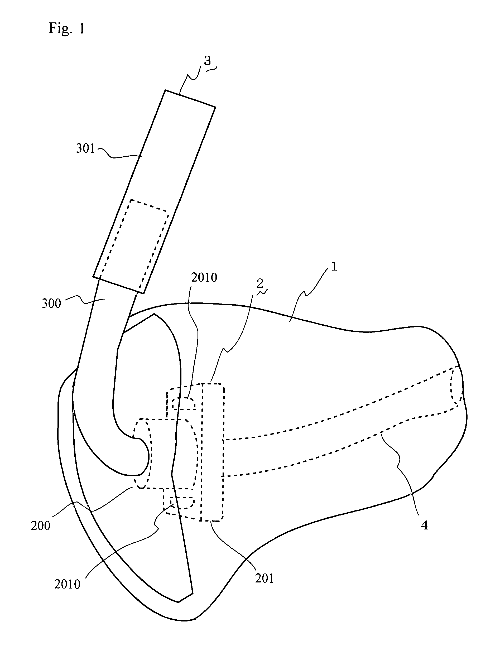 Ear Mold