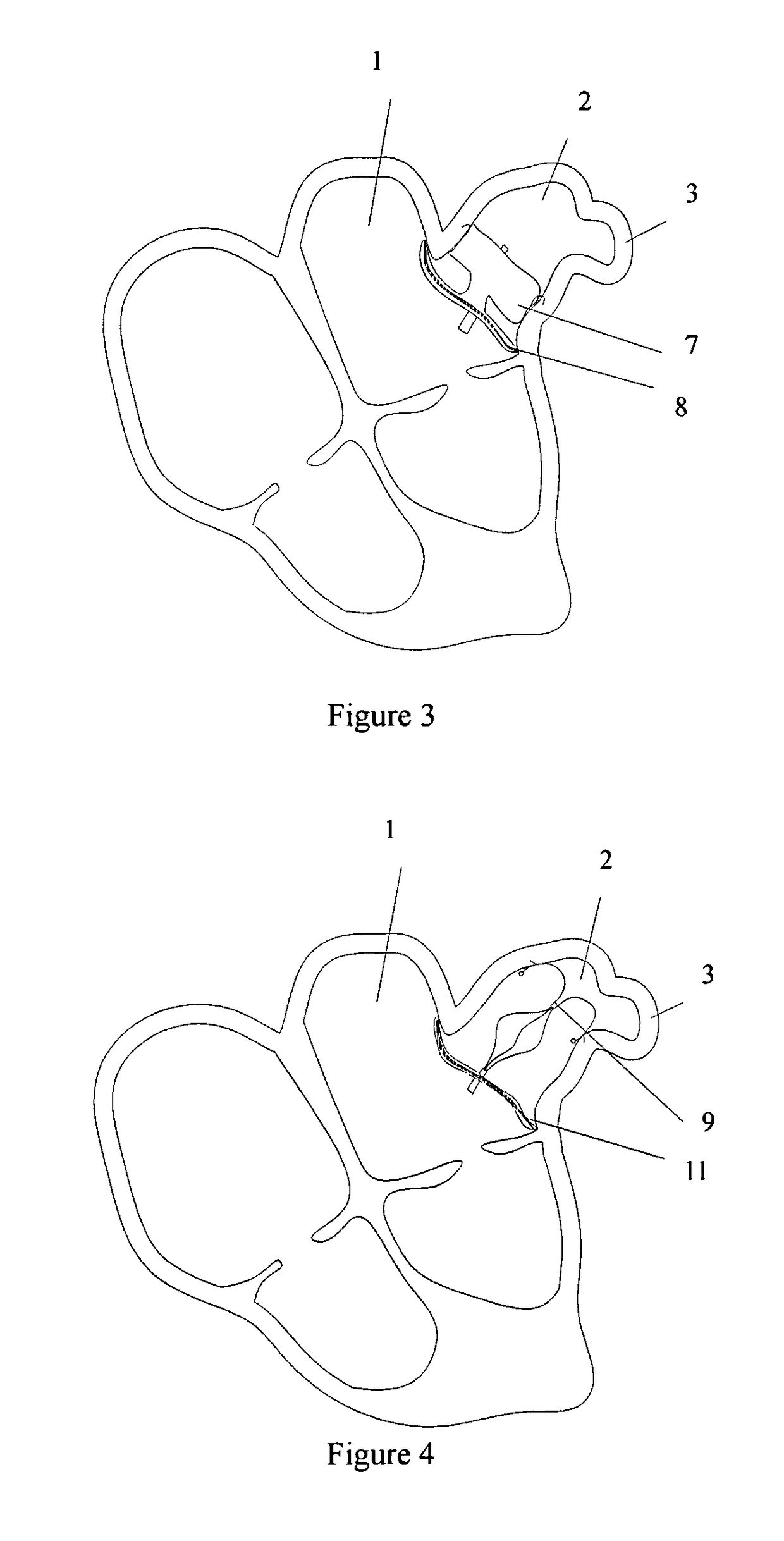 Left atrial appendage occluder