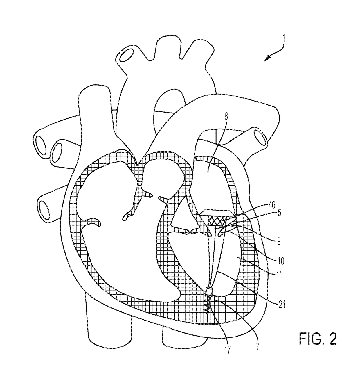 Transcatheter atrial anchors and methods of implantation