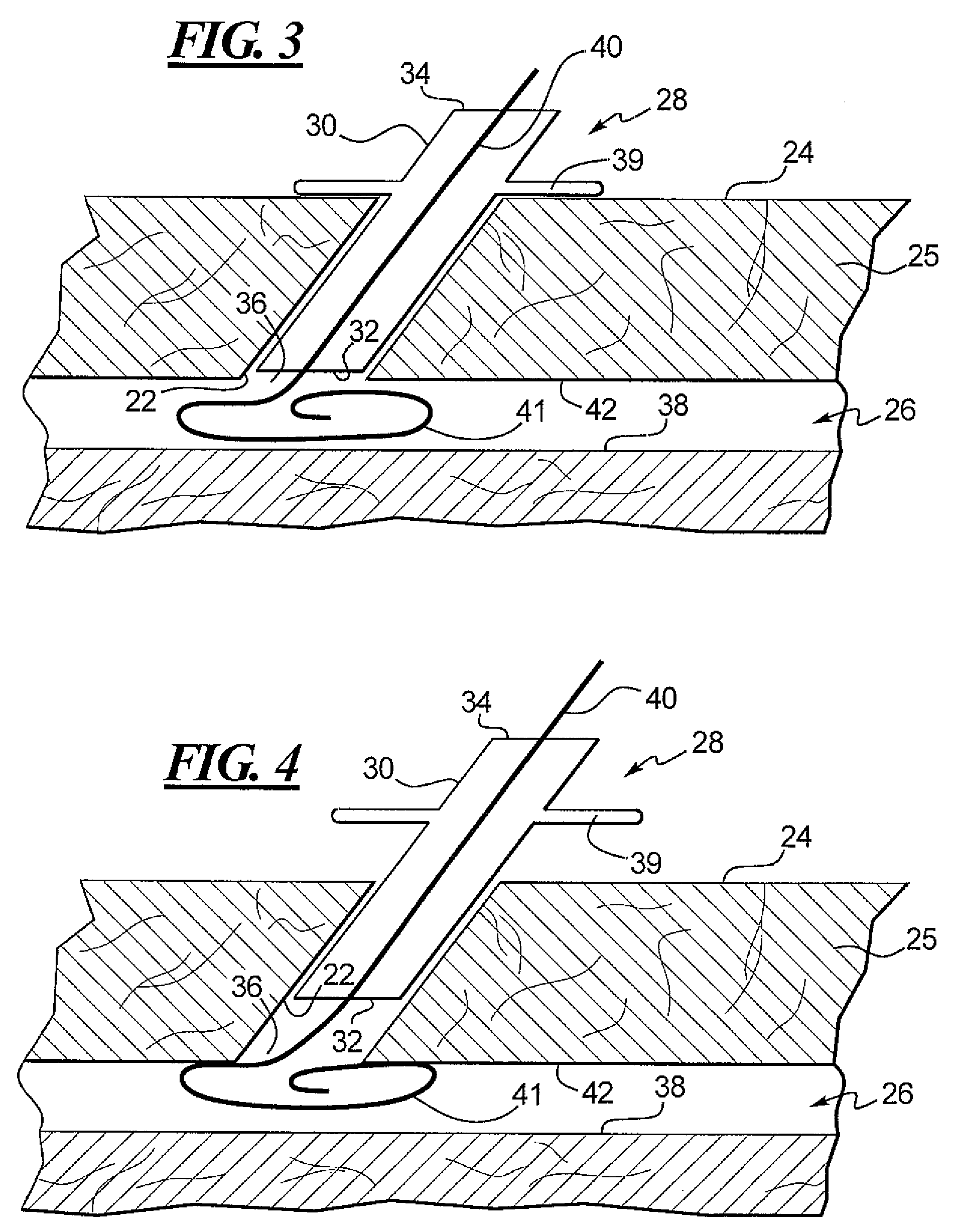 Apparatus and Method for Closing an Opening in a Blood Vessel Using Memory Metal and Collagen