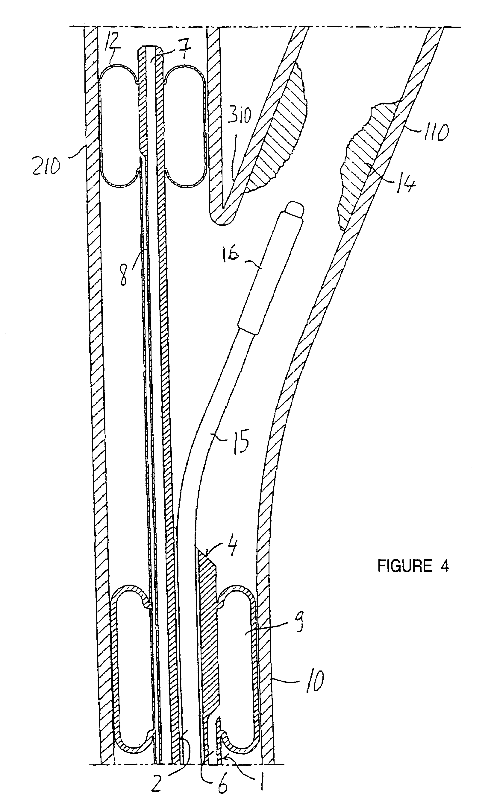 Endovascular system for the treatment of stenoses of the carotid and catheter for this system