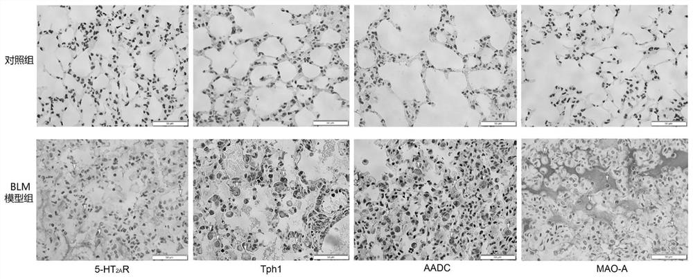 Application of compound medicine composition in preparation of medicine for treating interstitial pneumonia