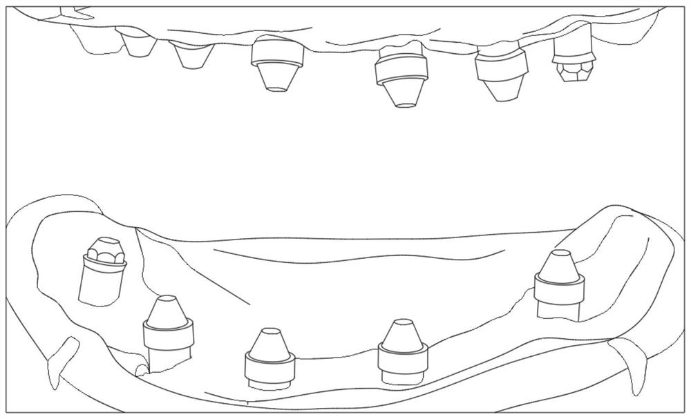 Processing technology for manufacturing implanted pure titanium bridge denture by combining additive and subtractive materials