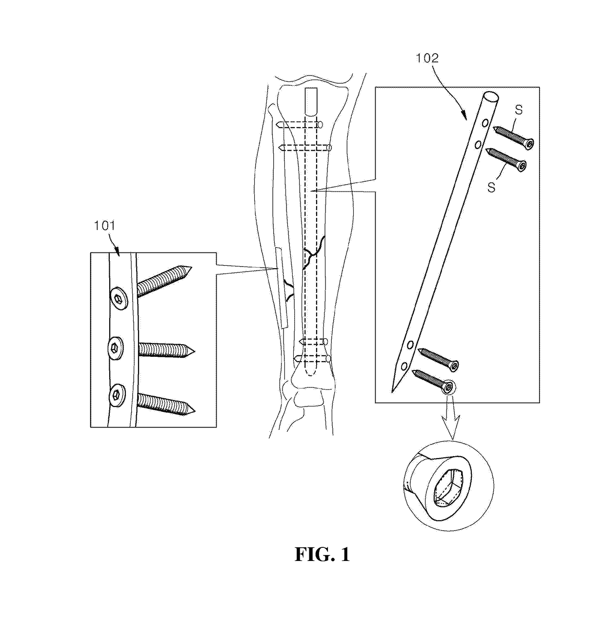 Human bone treatment unit