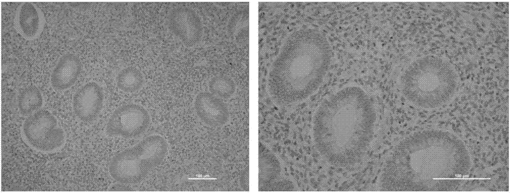 Molecular marker CD71 and applications in diagnosis, staging and prognosis of endometrial carcinoma