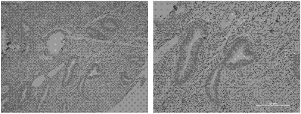 Molecular marker CD71 and applications in diagnosis, staging and prognosis of endometrial carcinoma