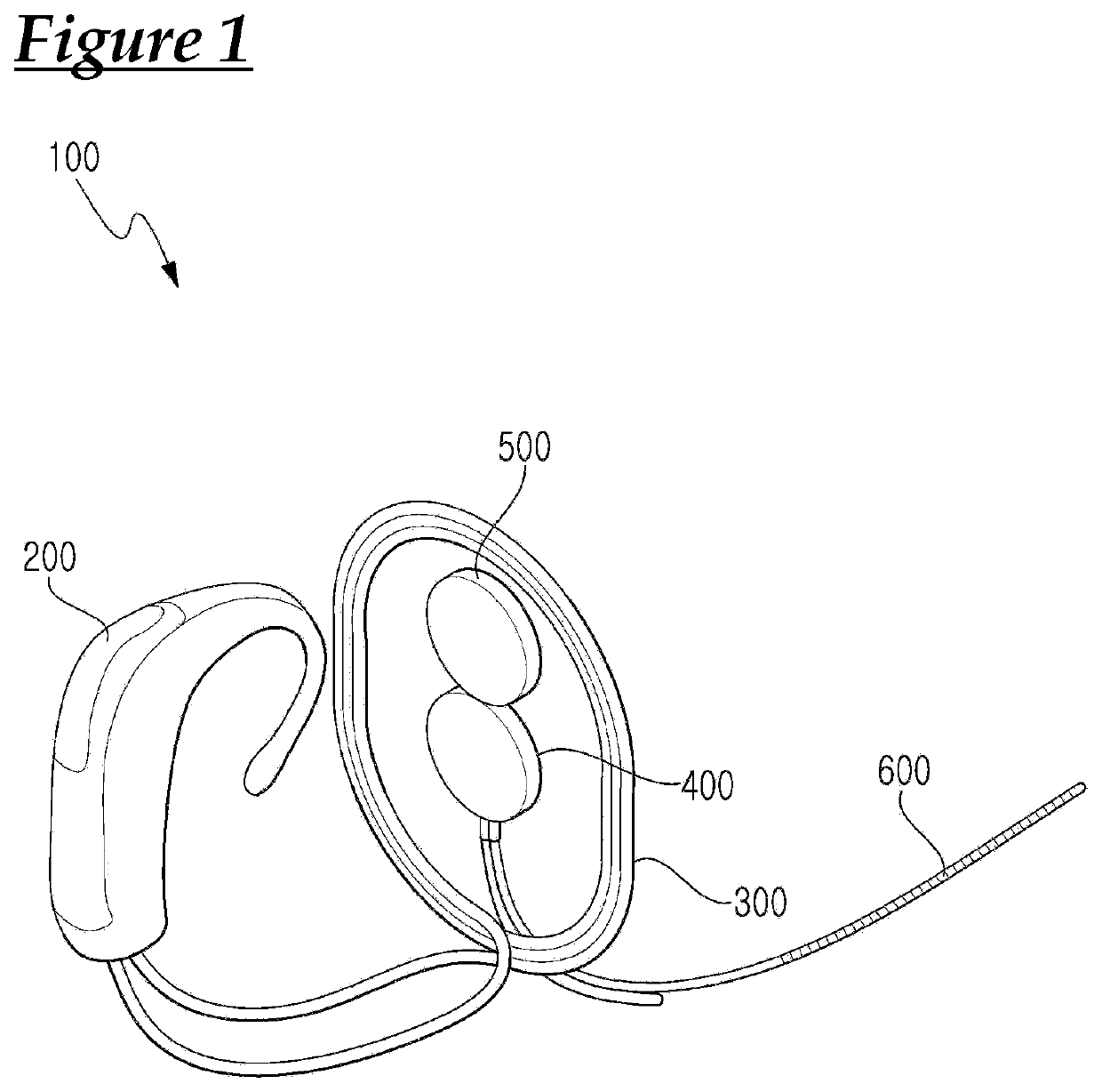 Cochlear implant