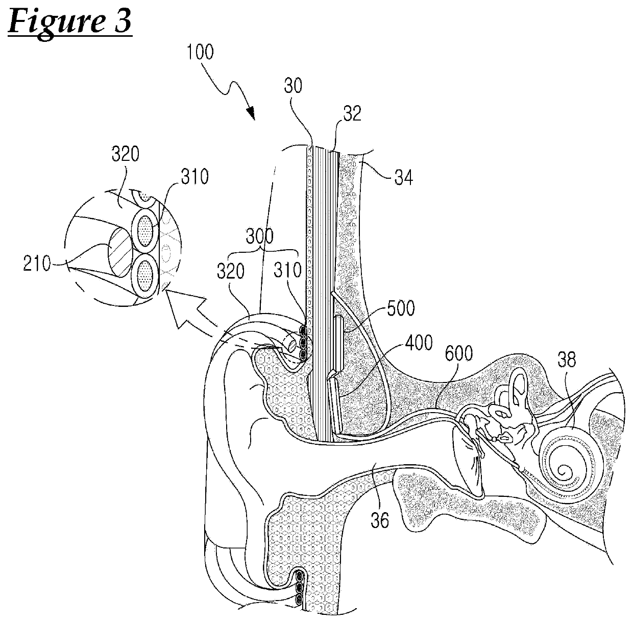 Cochlear implant