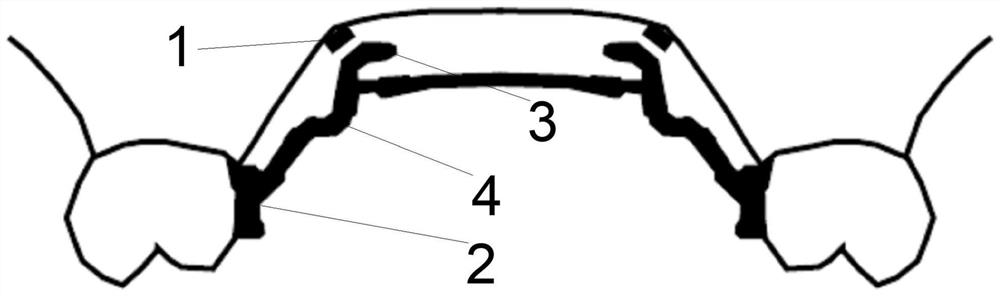 U-shaped palate rod for invisible correction of molar distal movement patient and correction method