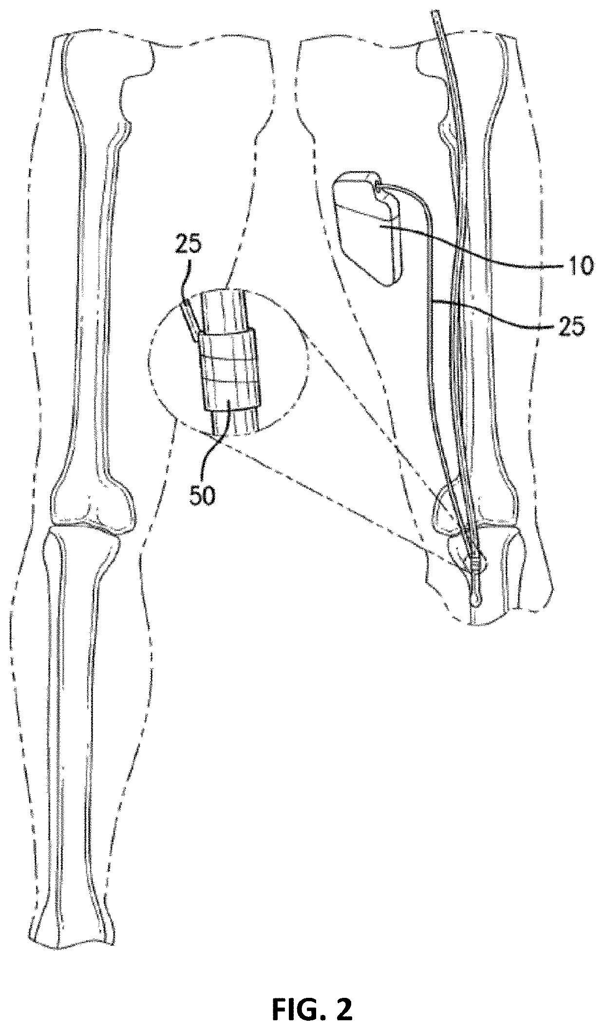 Nerve cuff electrode for neuromodulation in large human nerve trunks