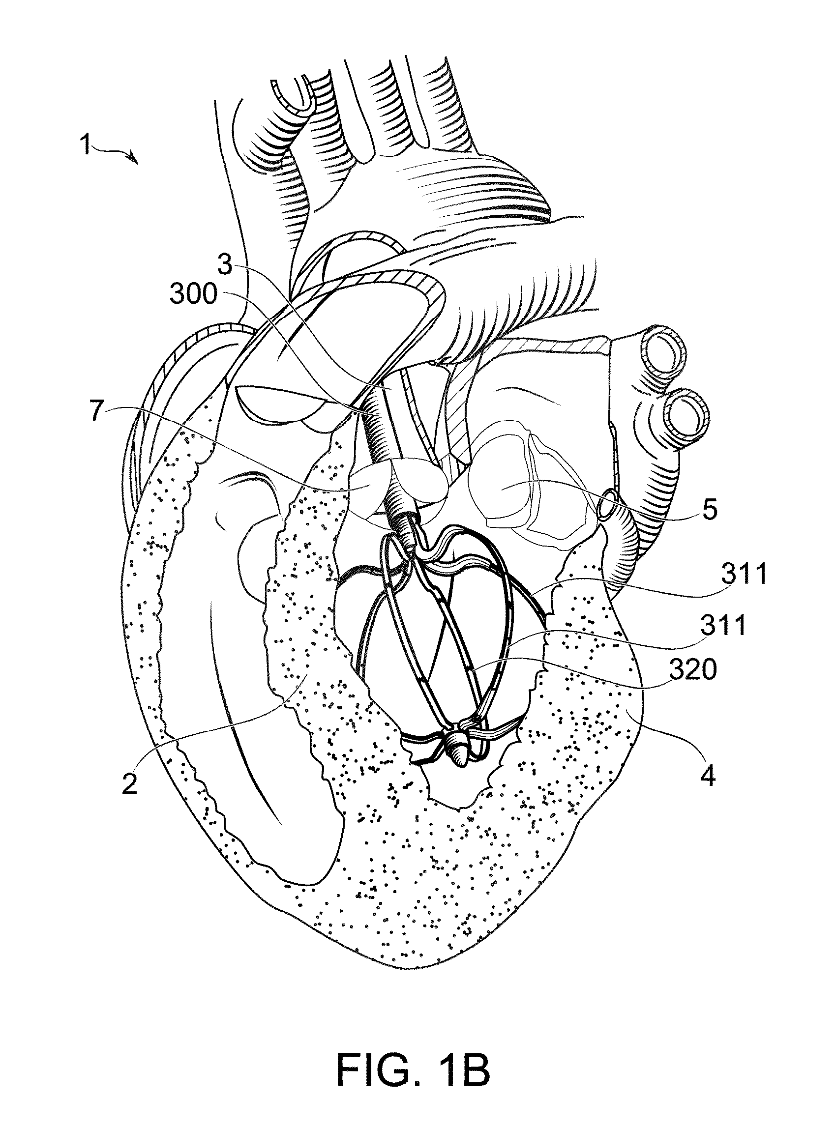 Myocardial ablation by irreversible electroporation