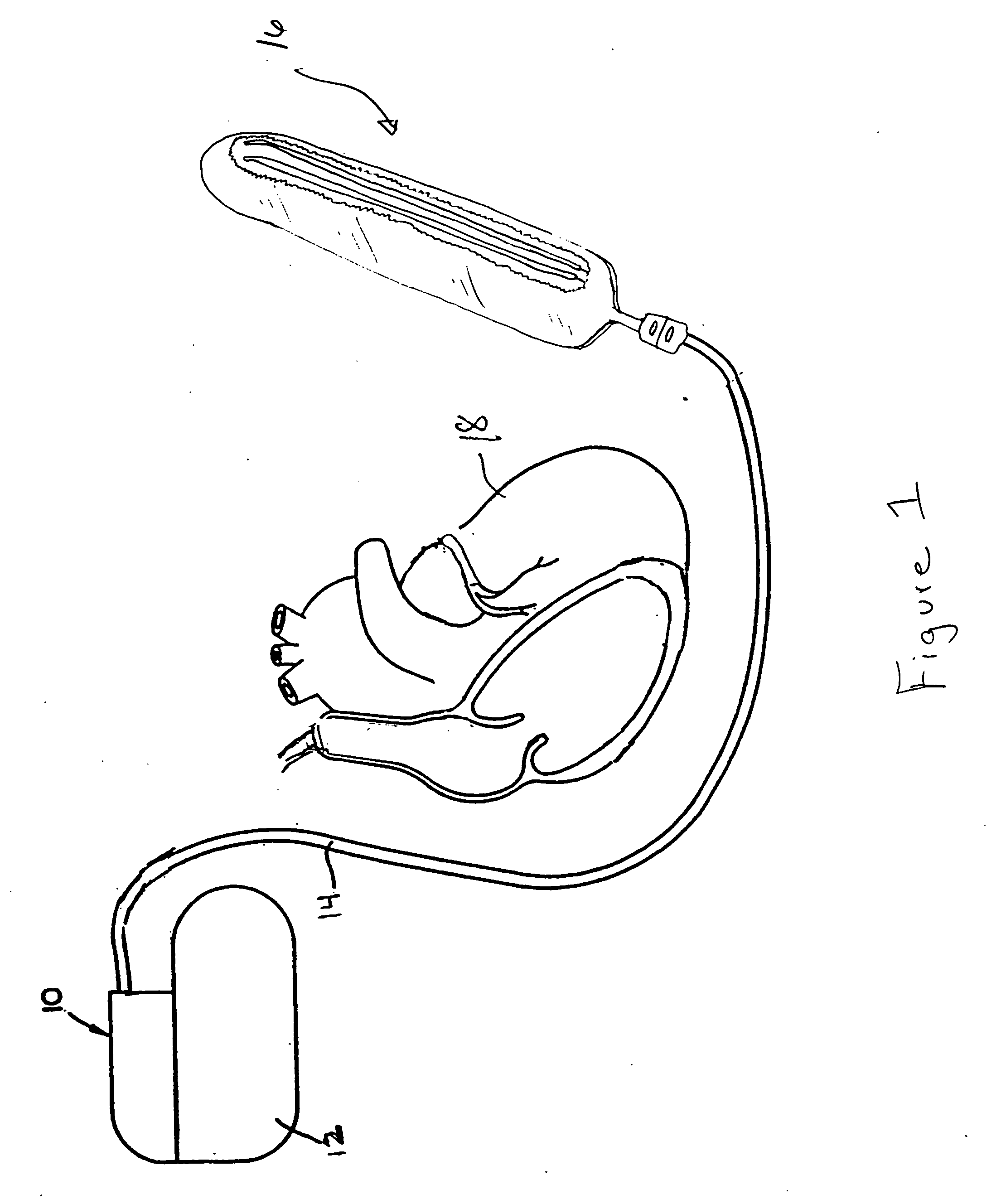 Subcutaneous lead system for detection and treatment of malignant ventricular arrhythmia