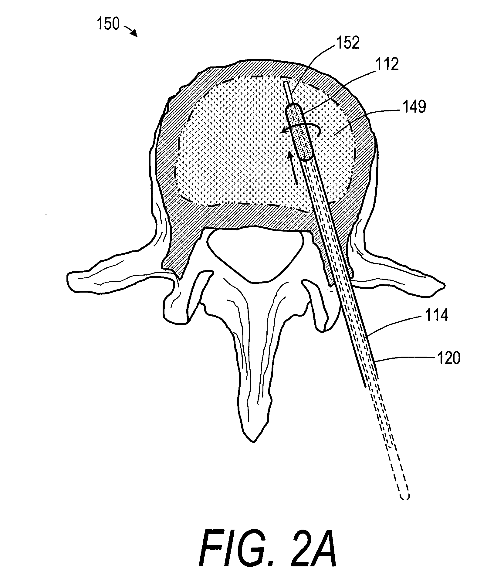 Bone treatment systems and methods for introducing an abrading structure to abrade bone