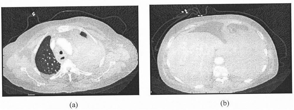 An Improved Active Shape Model Based Aortic Segmentation Method for CT Images