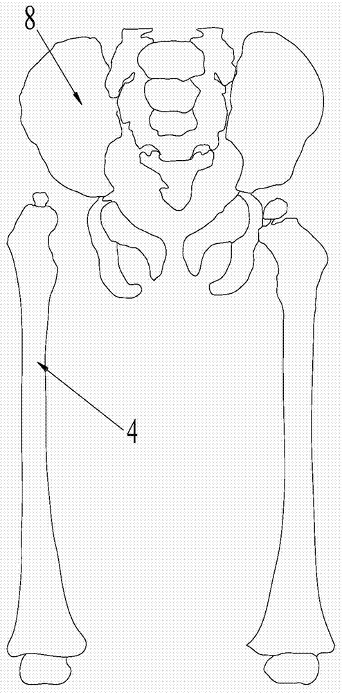 Femur osteotomy assistor