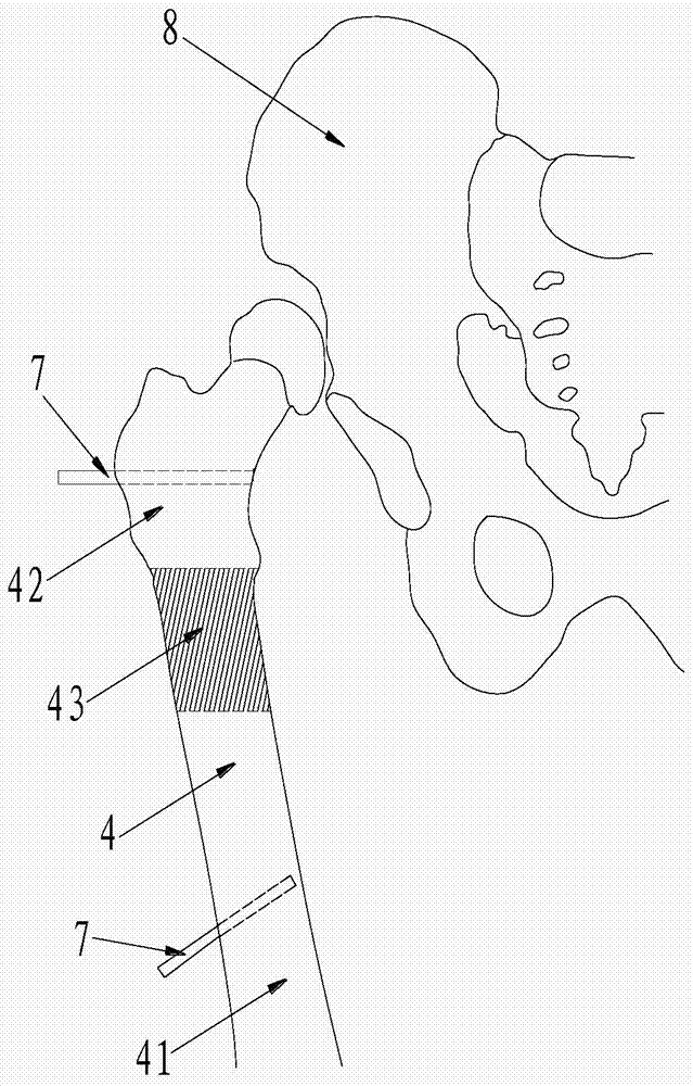 Femur osteotomy assistor