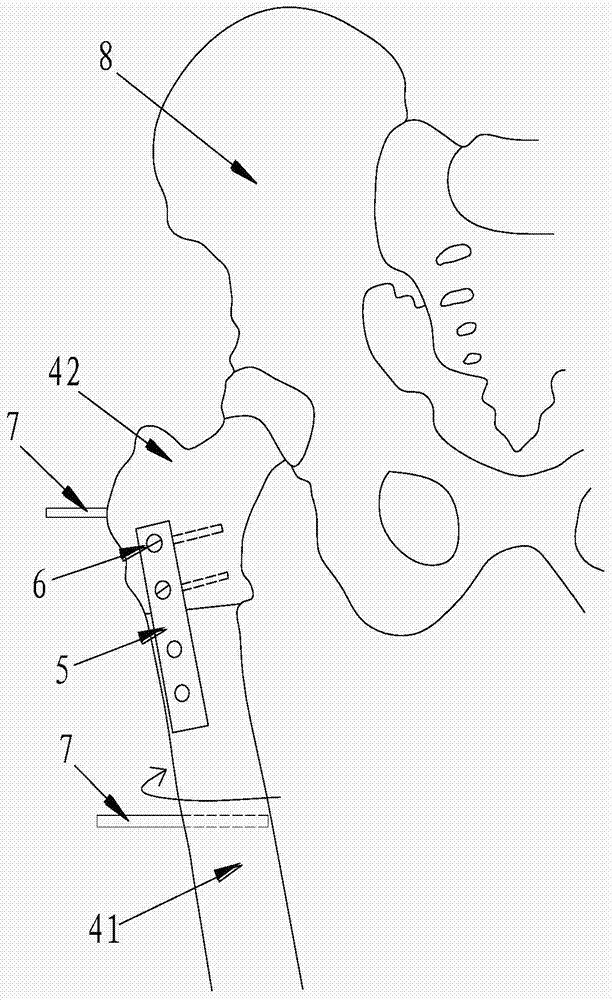 Femur osteotomy assistor