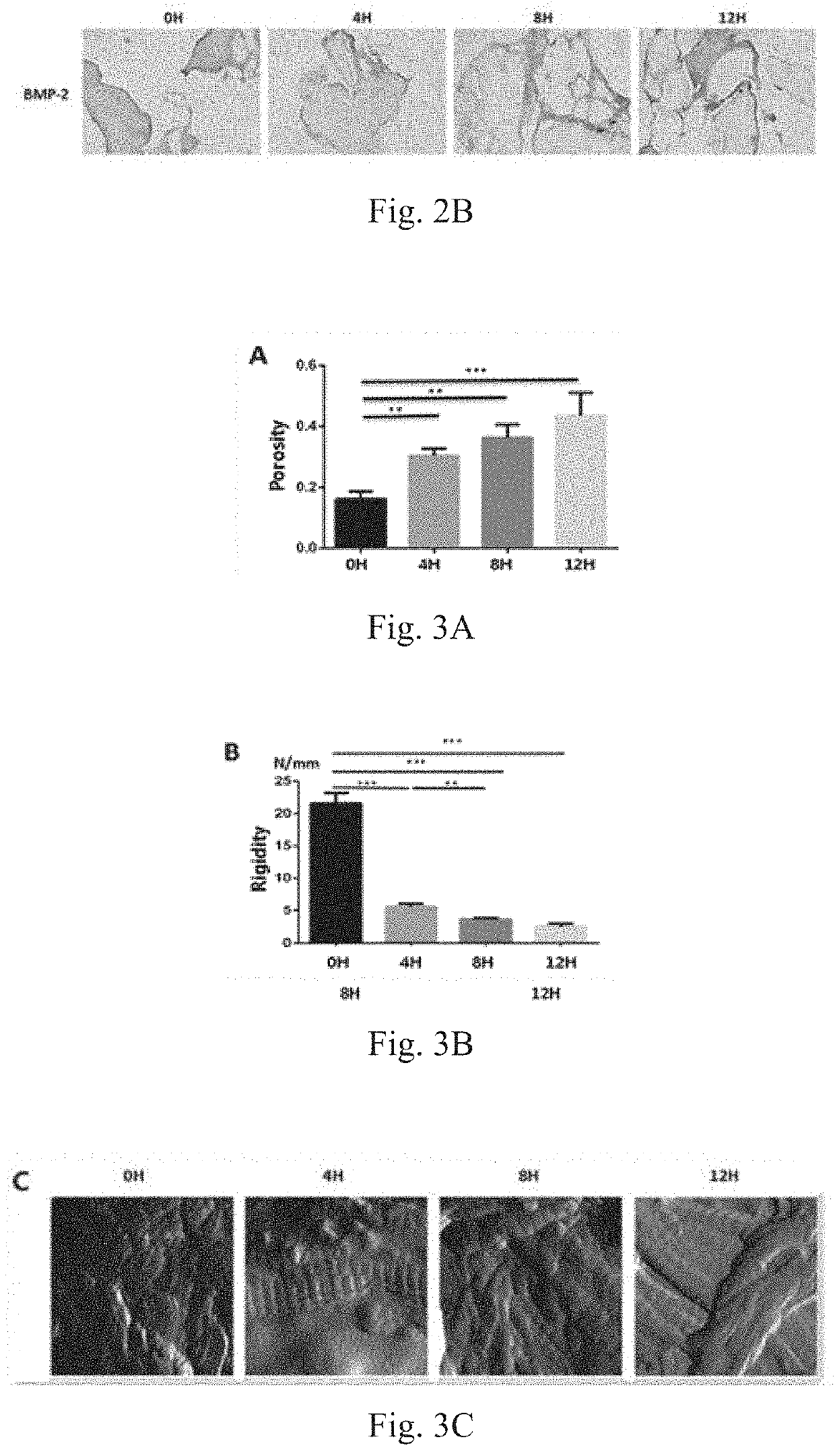 Preparation method of gradient mineralized cancellous bone matrix material