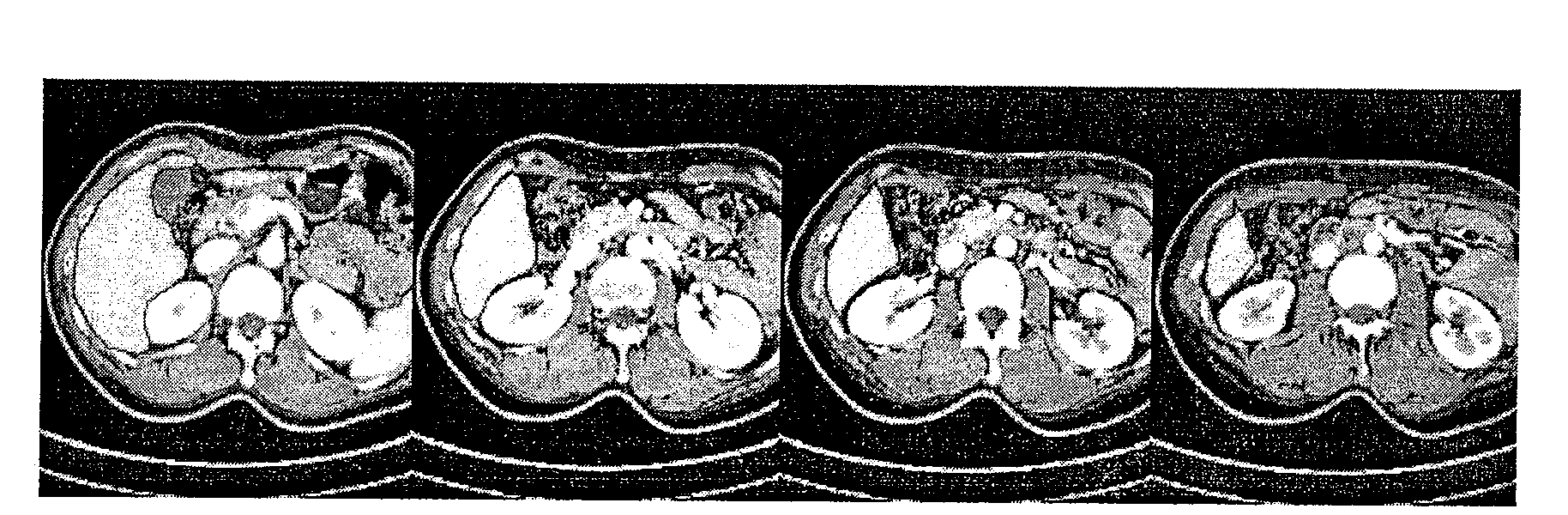 Method for sequence image segmentation based on movement forecast and three-dimensional constraining